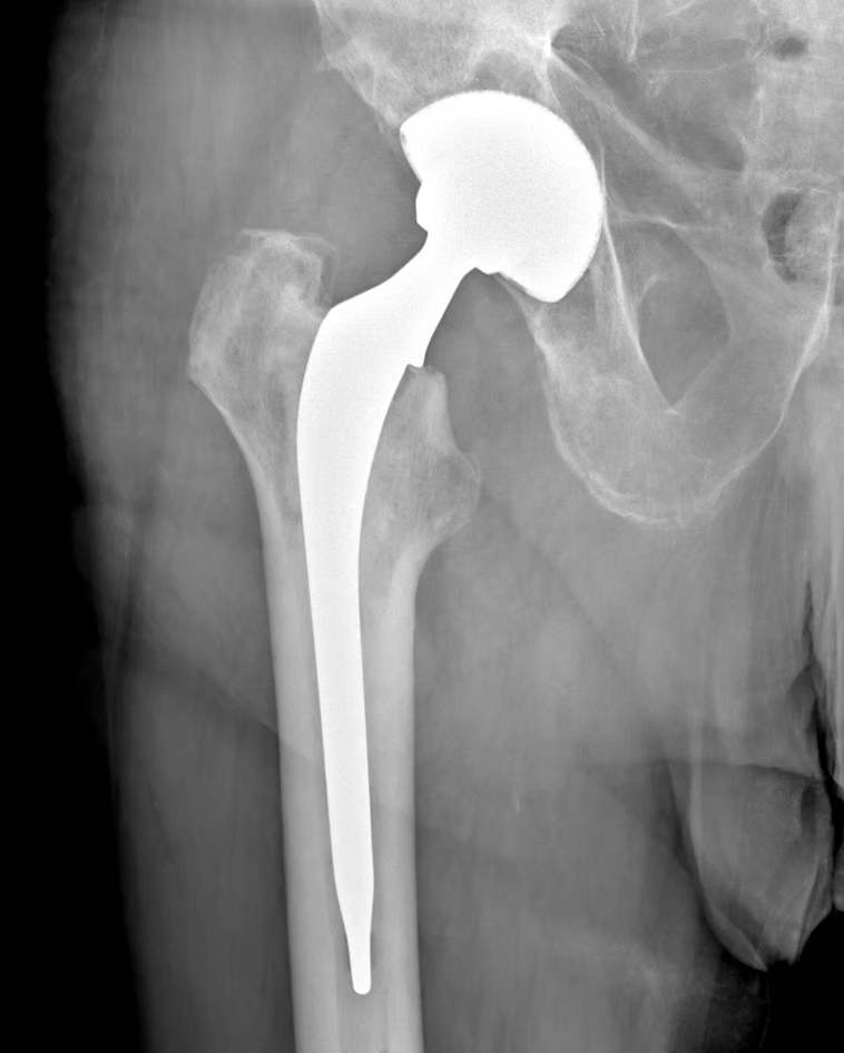 Radiografia dell'anca con protesi impiantata