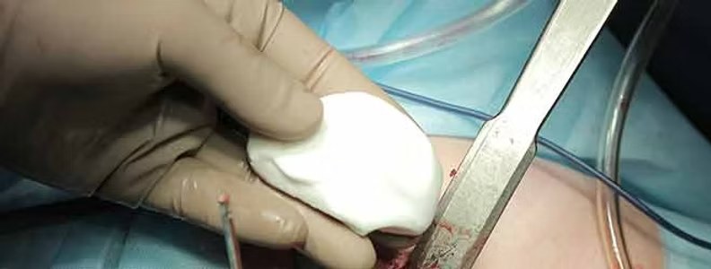 Cemento chirurgico utilizzato in sala operatoria