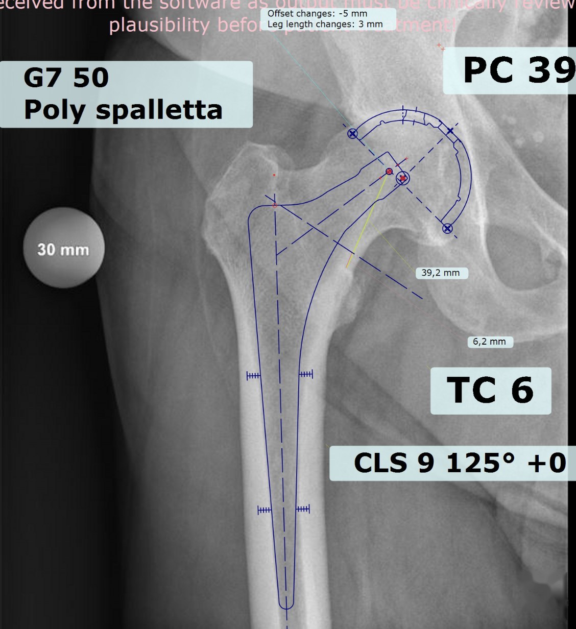 Pianificazione preoperatoria su radiografia del bacino