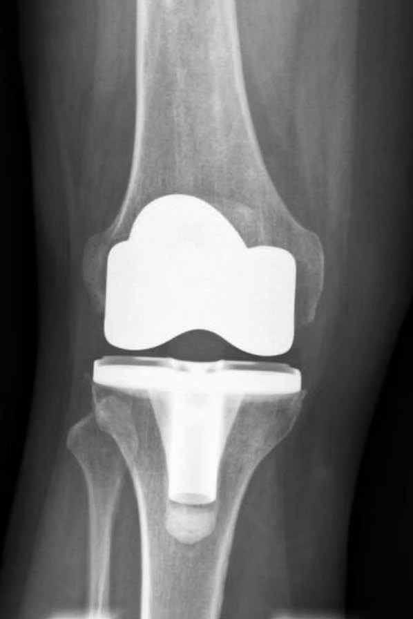 Radiografia di una protesi di ginocchio