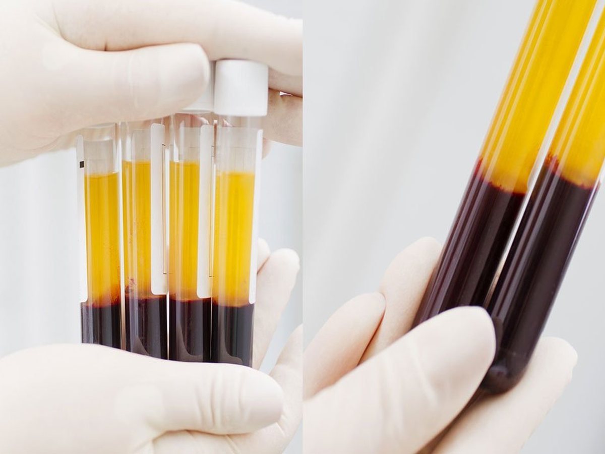 Provette di sangue centrifugato per la preparazione del PRP